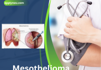 Mesothelioma Specialist Near Me